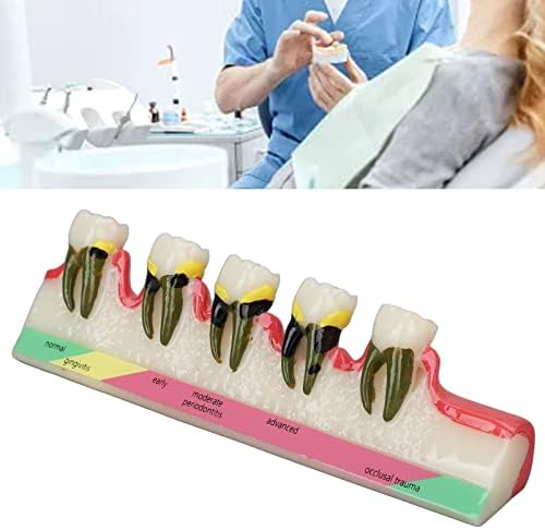 Shanrya TeensdiseAsemodel, Clearstructure DentalPathological Model