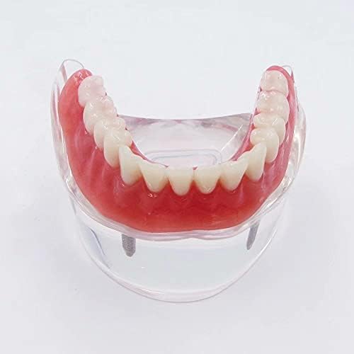 מודל הוראת שיניים יתר על המידה עם 4 שתלים, מודל שיקום שיניים בהוראה וחינוך